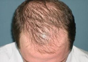 juuste väljalangemise põhjused