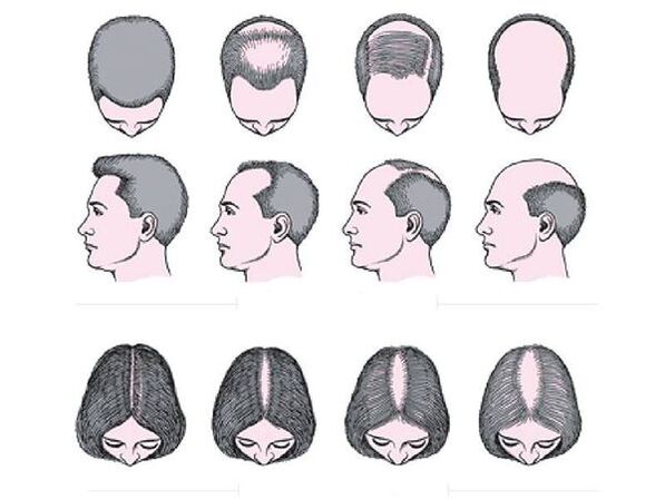 Androgeenne alopeetsia meestel ja naistel