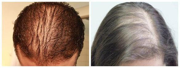 Hajus alopeetsia