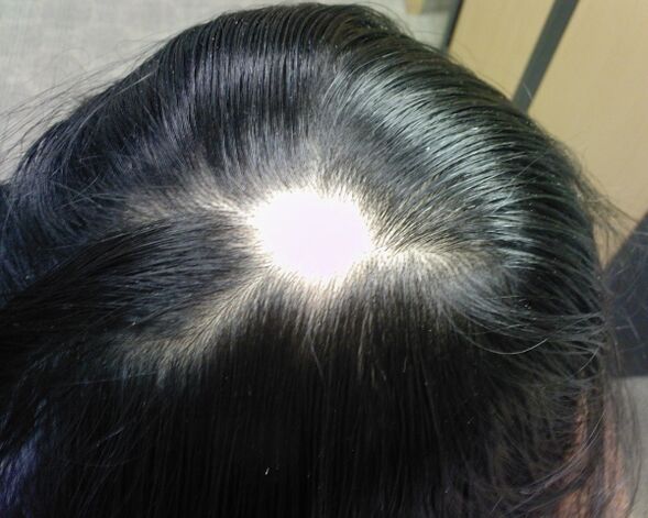 Alopeetsia areata või alopeetsia areata naistel