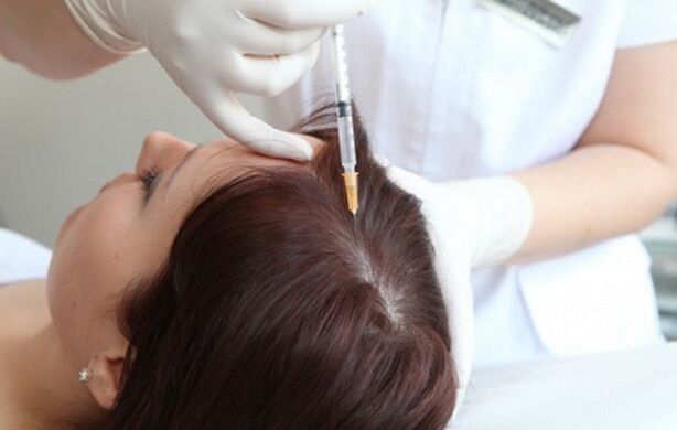 Mesoteraapia naiste alopeetsia ravis