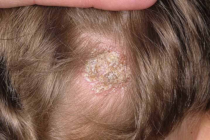 Seborroiline alopeetsia naistel