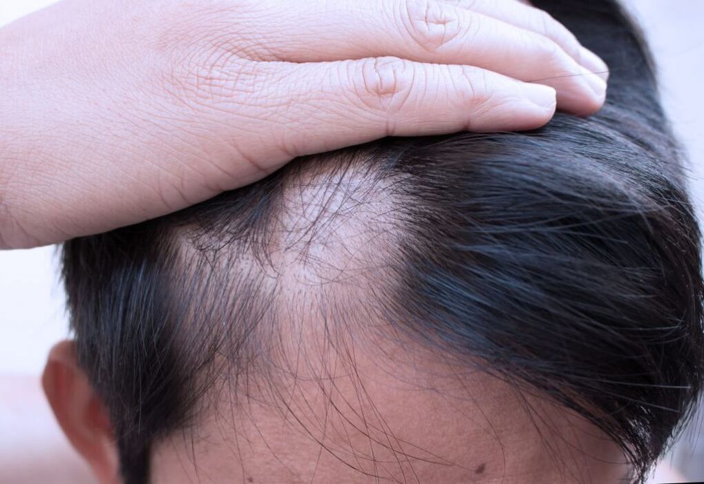 pea hajus alopeetsia