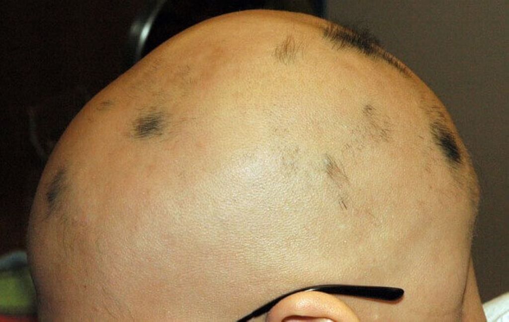 peanaha täielik alopeetsia meestel