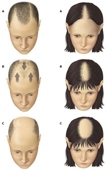 Androgeenne alopeetsia meestel ja naistel