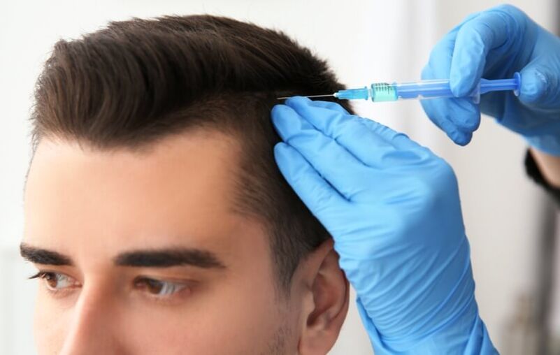 Mesoteraapia juuste kasvu stimuleerimiseks androgeense alopeetsia korral